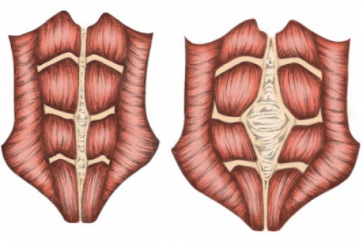 Diastaza mięśni brzucha